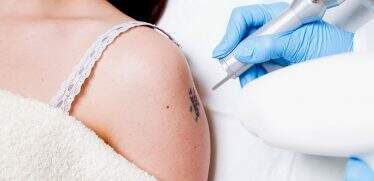 Dúvidas sobre remoção de tatuagens