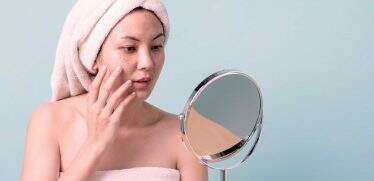 Melasma